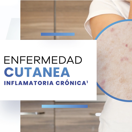 ¿Qué es la dermatitis Atópica?