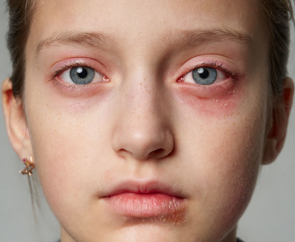 child with bruises