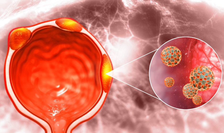 Conoce más sobre la hiperplasia prostática benigna