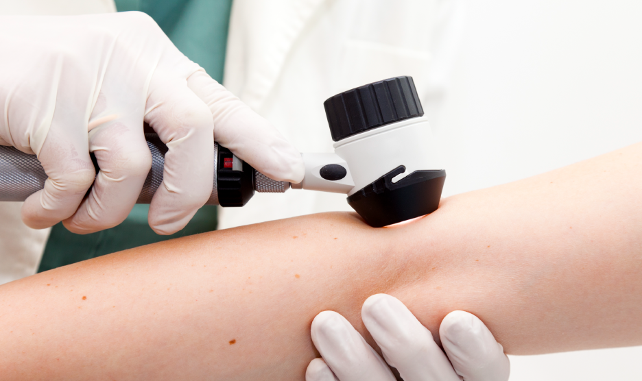 Melanoma: datos de alarma y prevención