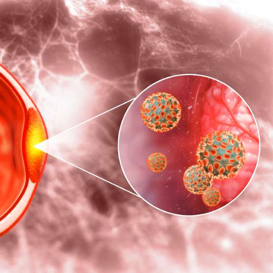 Conoce más sobre la Hiperplasia Prostática Benigna