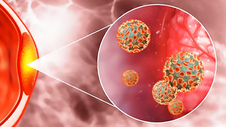 Conoce más sobre la Hiperplasia Prostática Benigna